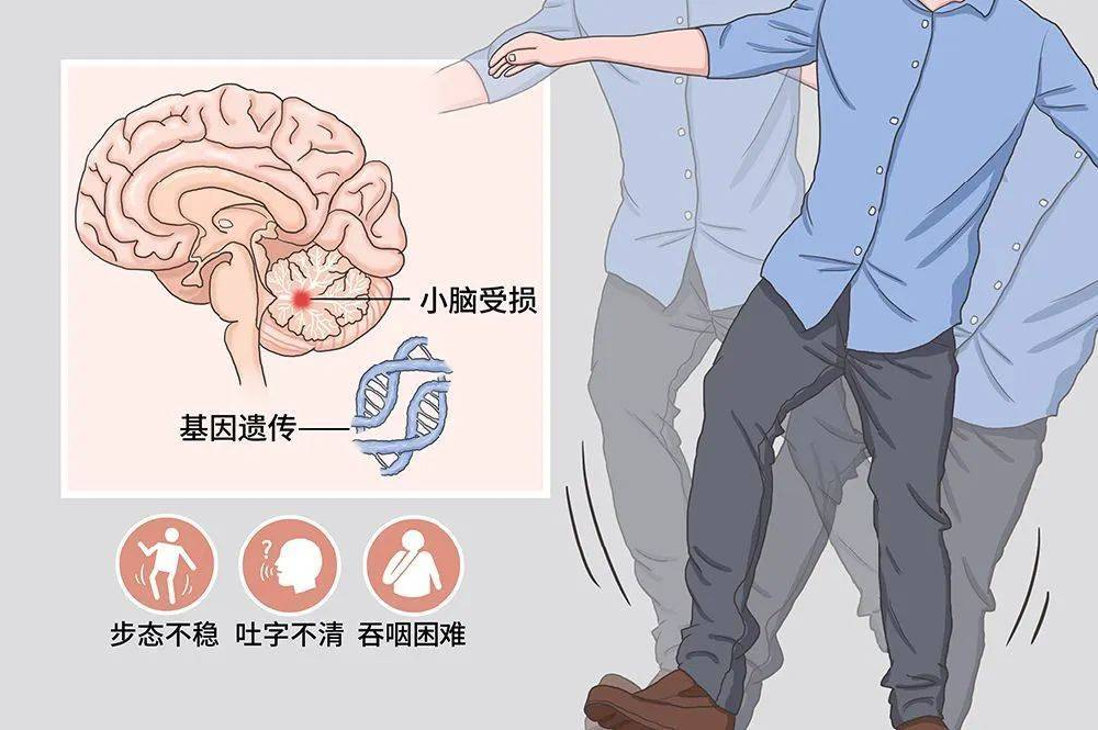 从“协调性差”到“生活失能”:共济失调的渐进式危机 ——当身体平衡失控,人生如何“站稳”?