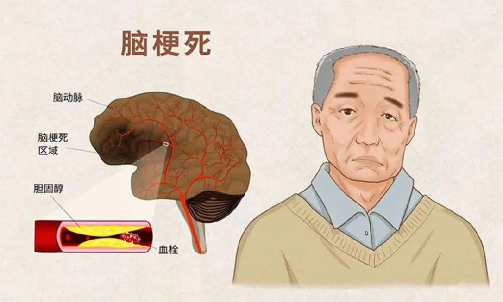 【案例纪实】七旬老人脑梗昏迷险成植物人！神经修复让他从 