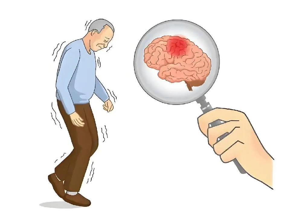 帕金森病病程阶段全解析:了解各阶段特点,科学应对挑战