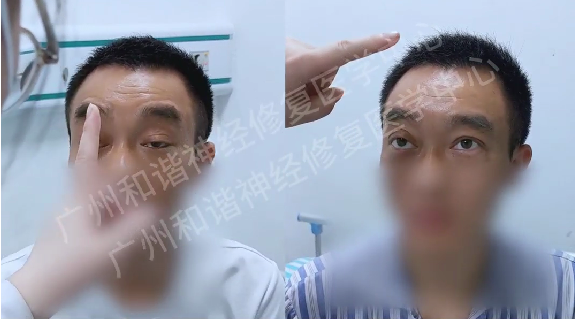 【案例纪实】神经修复攻克重症肌无力 20 年顽疾，眼睑下垂终改善，睁眼不再艰难|广州重症肌无力该怎么治疗呢？