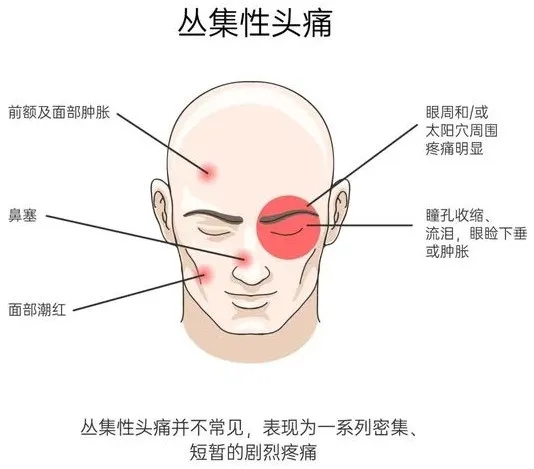 【案例纪实】每晚数着分钟等天亮：51 岁阿姨被头痛折磨 2 年，靠微创技术睡了第一个整觉|广州哪里治疗丛集性头痛有效