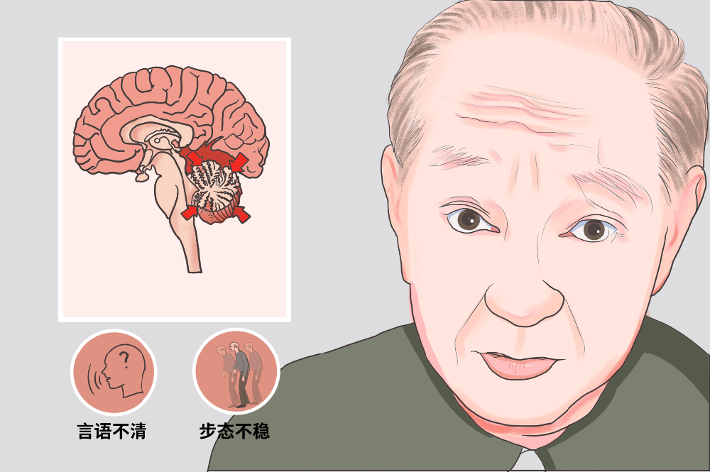 脑萎缩会导致什么后果?一文读懂大脑“萎缩”背后的健康危机
