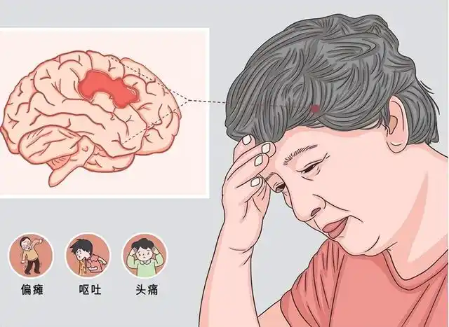 脑出血后遗症请收好这4个康复训练方法，帮助恢复