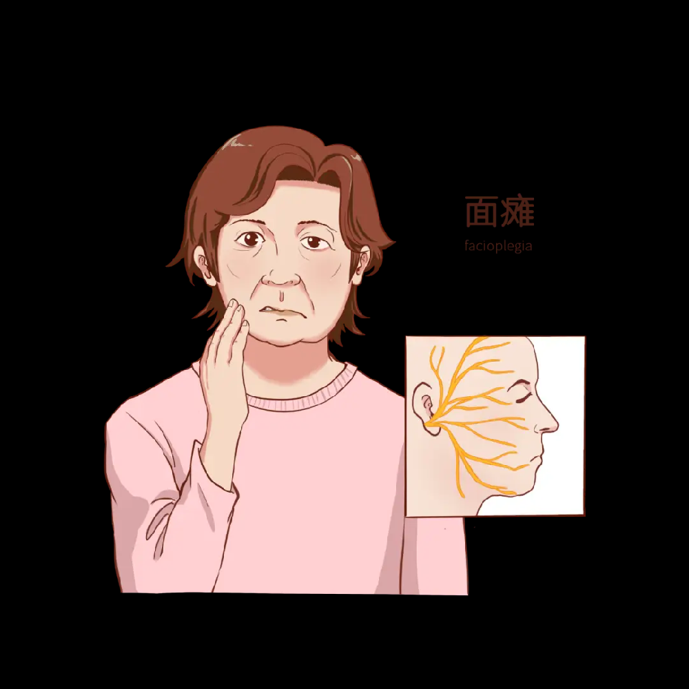 面瘫多久能好?会不会留下后遗症?答案来了!