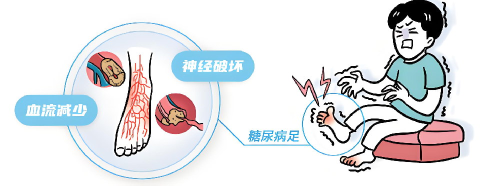 一文读懂!糖尿病周围神经病变三阶段:从隐匿到严重的演变历程