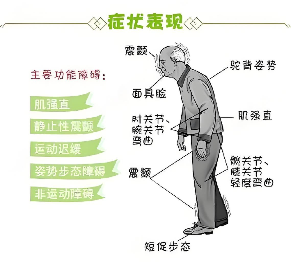 患者关注点：帕金森肢体僵硬会影响寿命吗？