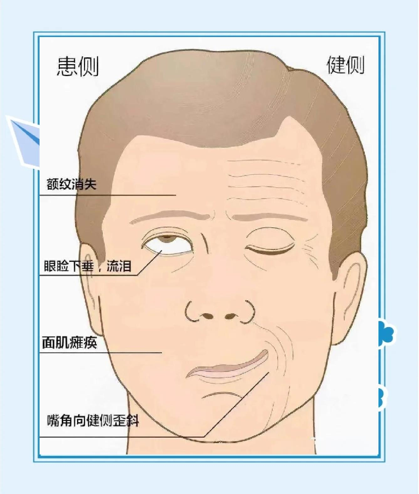 面瘫发作的五大信号,你注意到了吗?