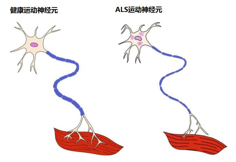 关于运动神经元病肌肉“跳动-萎缩”的四大疑问解答