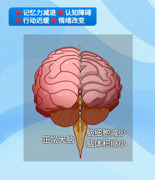 体检发现“脑萎缩”,这该怎么办?