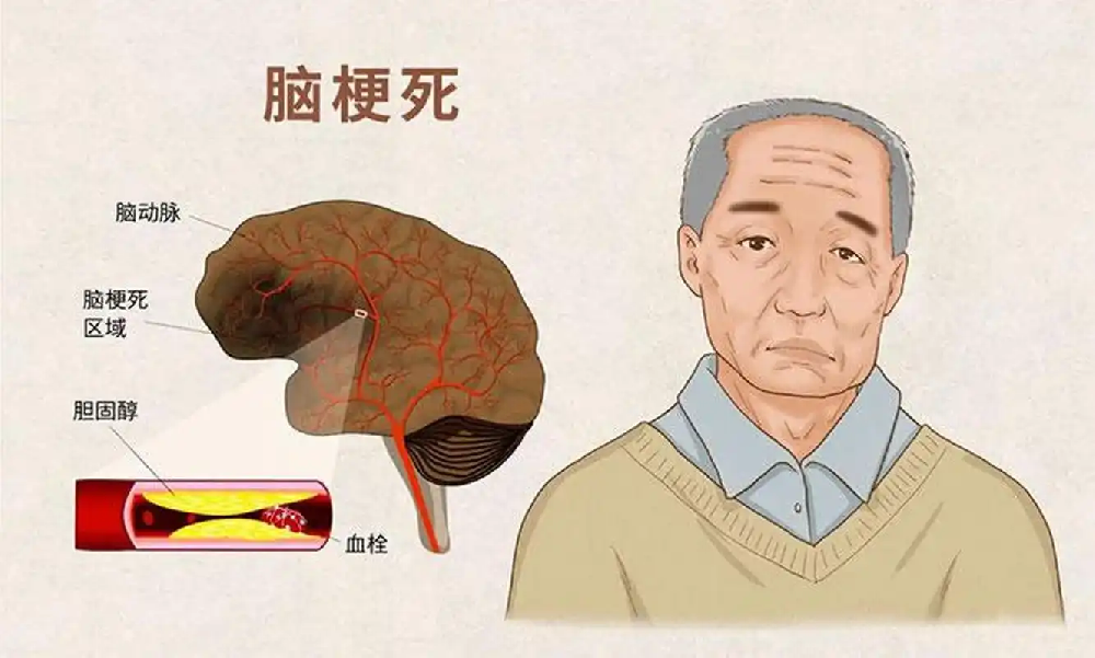 脑梗后遗症的这些迹象：说明神经功能正在恢复