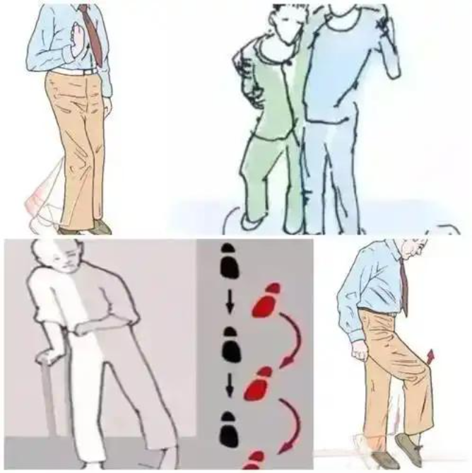 偏瘫患者为何步态各异?一文读懂常见表现