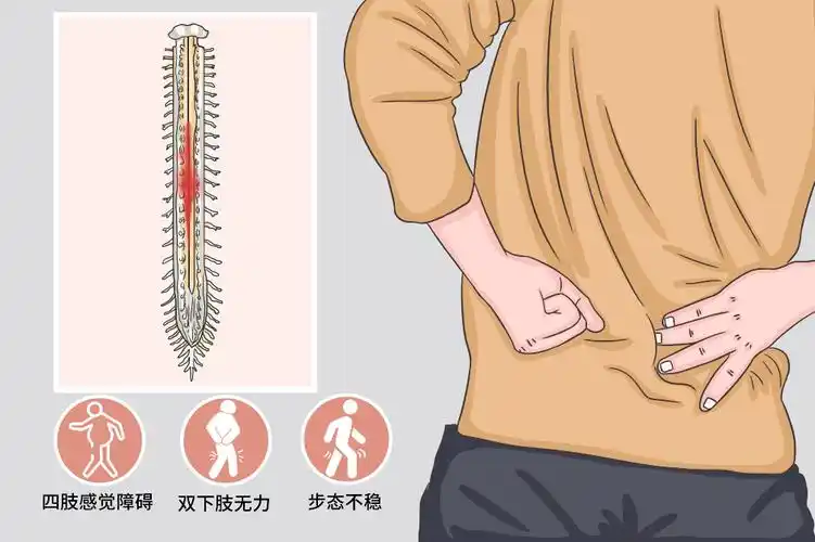 脊髓损伤患者居家康复指南：简单易行的安全训练法