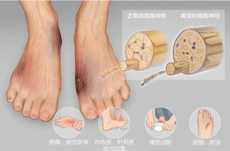 糖尿病周围神经病变:饮食与护理误区全解析