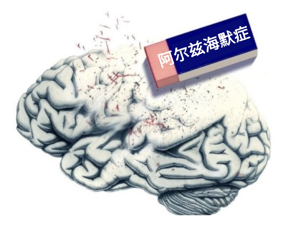 阿尔茨海默症:不只是老年人的问题