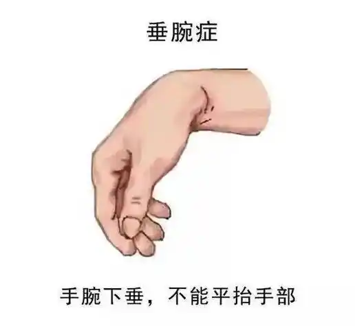 手腕无力下垂？小心是臂丛神经损伤了