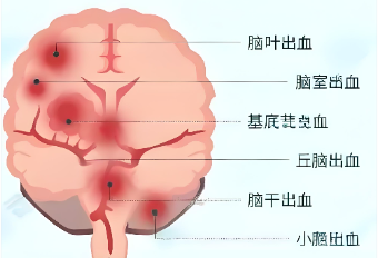 脑出血位置不同，后果天差地别！一文看懂4种常见出血的信号