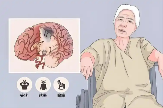 脑梗前兆有哪些？出现这3个信号要警惕