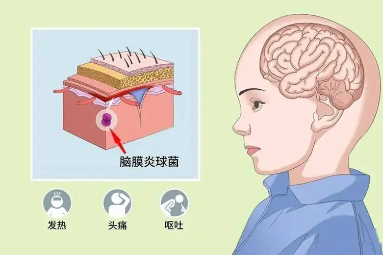 癫痫：大脑突然“放电”了