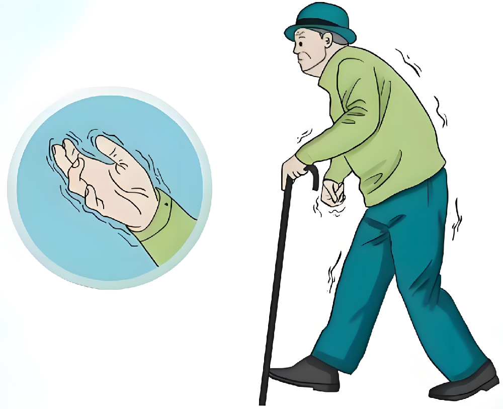 帕金森病：不是“老了抖”，而是大脑里的“指挥家”倒下了