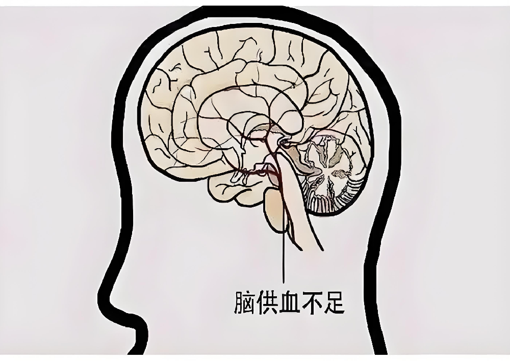 别把脑供血不足当“累了”！4个信号，早发现早应对