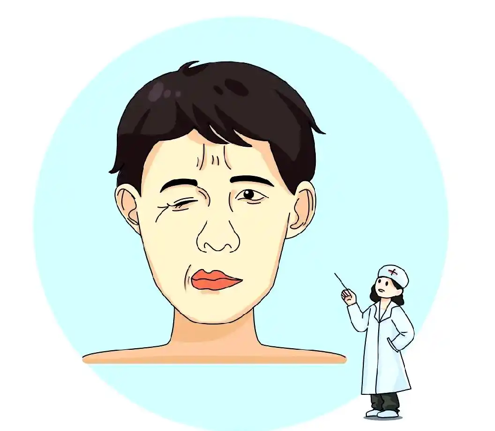 面瘫后遗症分4种典型表现，对照看看你属于哪一种