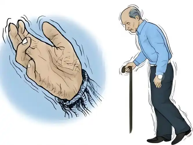帕金森病分3个阶段，看懂不同程度的信号与应对
