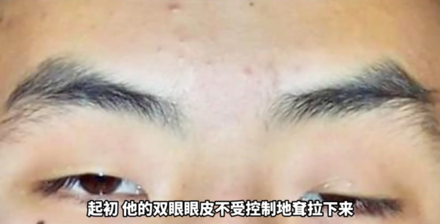 【康复案例】用药两年不见效！10岁患儿眼睑下垂、眼球流动障碍，神经修复综合治疗让其双眼灵动如初_重症肌无力康复记实