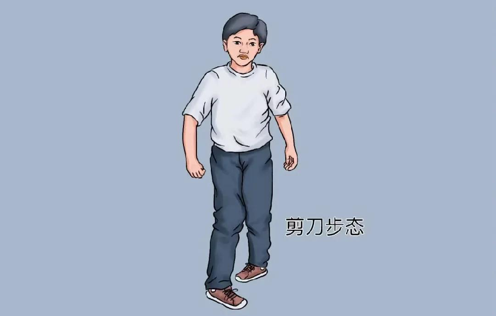 走路姿势藏着神经健康密码，带你认识神经内科最常见的五种异常步态
