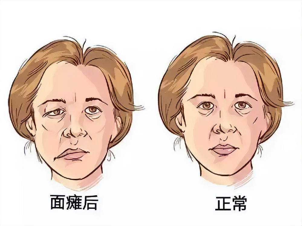 周围性面瘫分三大阶段,别等留下后遗症才重视!