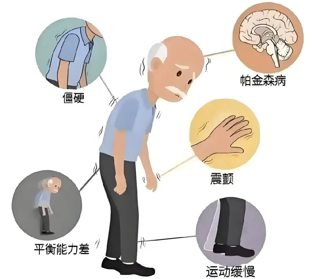 帕金森易被忽略的三大早期信号，别等手抖才就诊