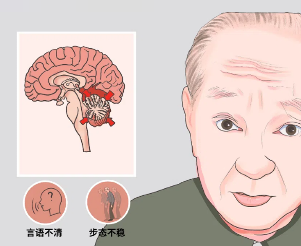 小脑萎缩会持续加重吗?别掉以轻心!日常护理抓准这几点
